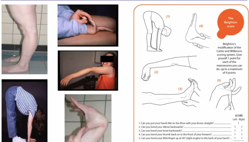 Valutazione dell'iperlassità articolare con il Beighton score. Immagini mostrano flessibilità di gambe, dita e schiena.