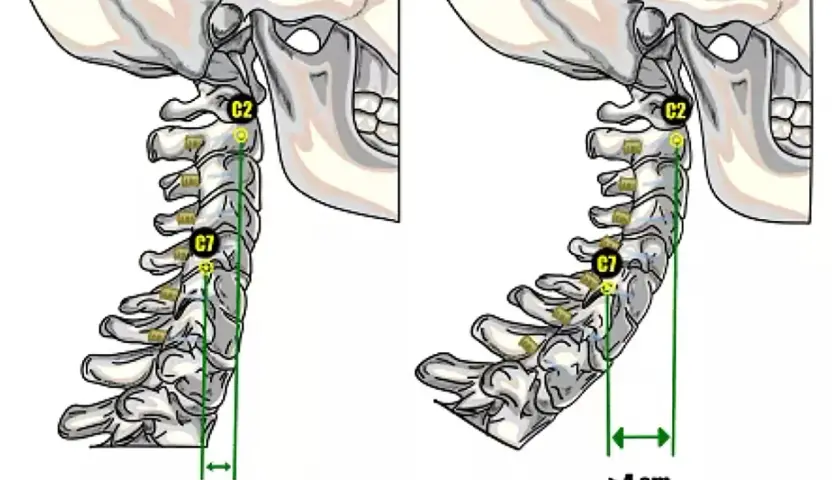 Confronto tra colonna cervicale normale (1.5 cm) e iperlordosi cervicale (>4 cm).