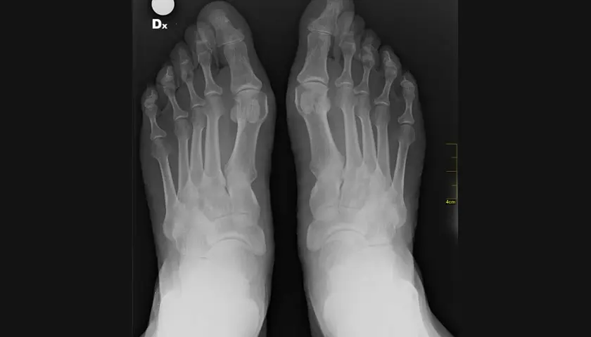Radiografia dei piedi che mostra un marcato alluce valgo angolo, con deviazione dell'alluce verso le altre dita.