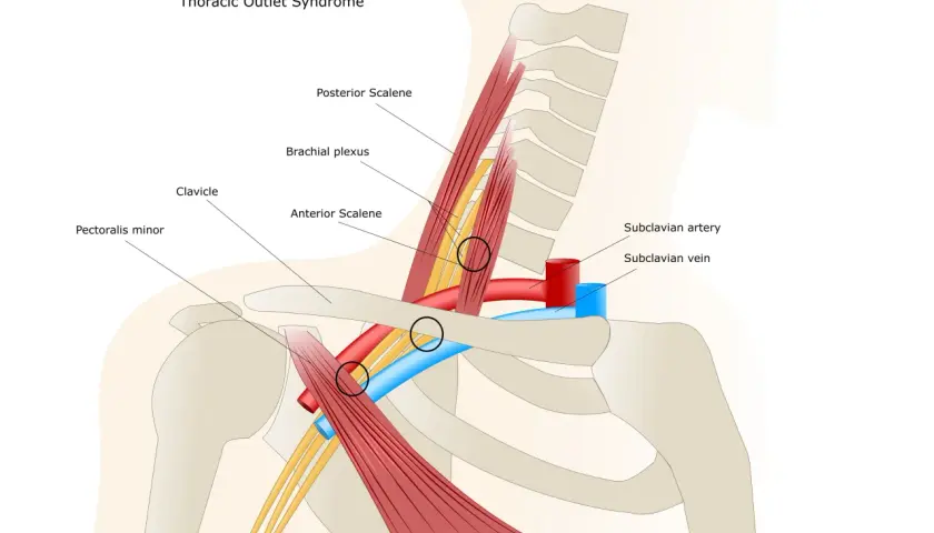 Illustrazione anatomica che mostra le strutture coinvolte nella sindrome dello stretto toracico. Evidenzia la compressione del plesso brachiale e dei vasi sanguigni.