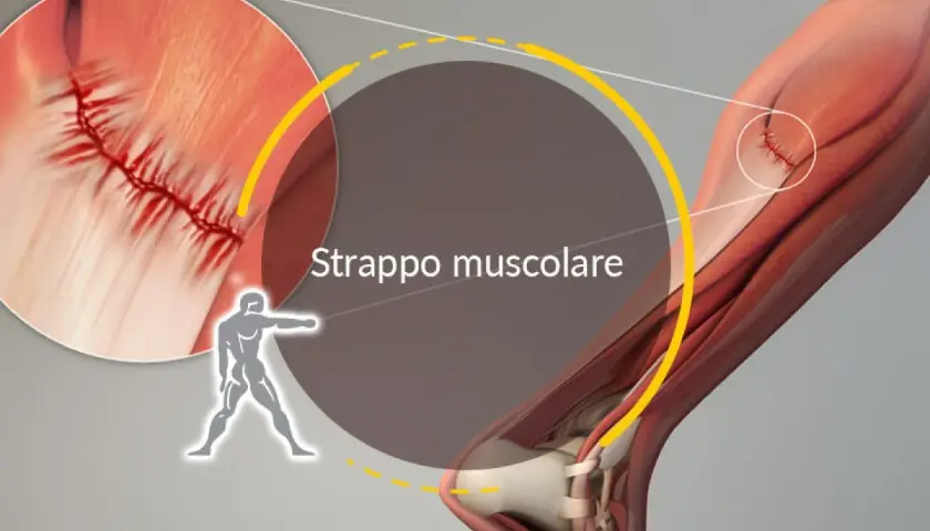 Dettaglio di uno strappo muscolare con suture. L'immagine illustra la lesione e i tempi di recupero.