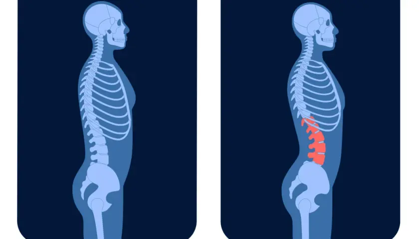 Confronto tra colonna vertebrale normale e lordosi. La lordosi cura è un percorso per correggere l'eccessiva curvatura lombare.