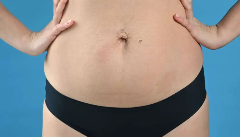 Addome con smagliature, un ombelico e un neo. La tecnica Tupler può aiutare a migliorare l'aspetto.