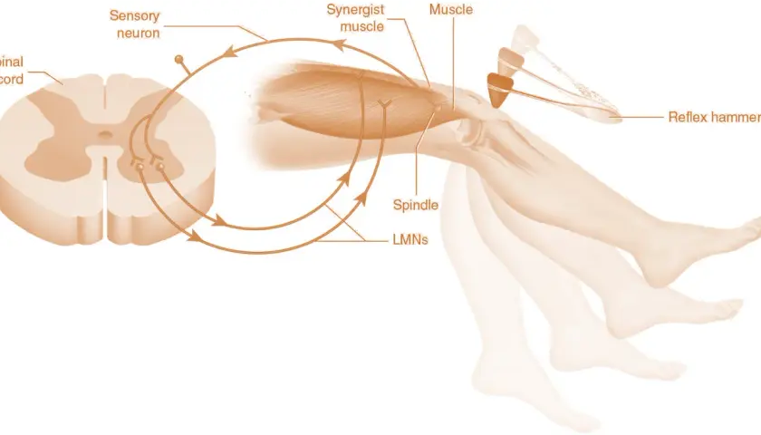 Schema del riflesso patellare: martelletto colpisce ginocchio, innescando un segnale nervoso che, passando per il midollo spinale, causa contrazione muscolare e movimento della gamba, evidenziando l'ipertono muscolare.