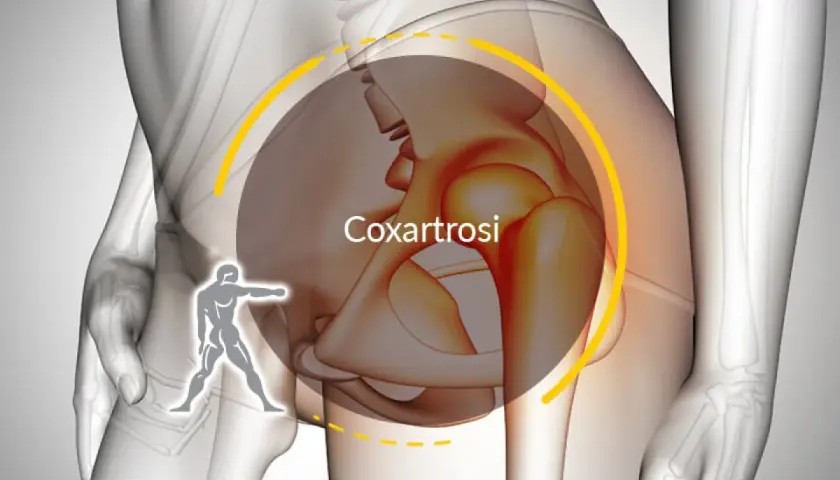 Illustrazione anatomica dell'anca con la scritta "Coxartrosi". Un omino stilizzato indica la zona dolente, suggerendo che si guarisce da coxalgia.