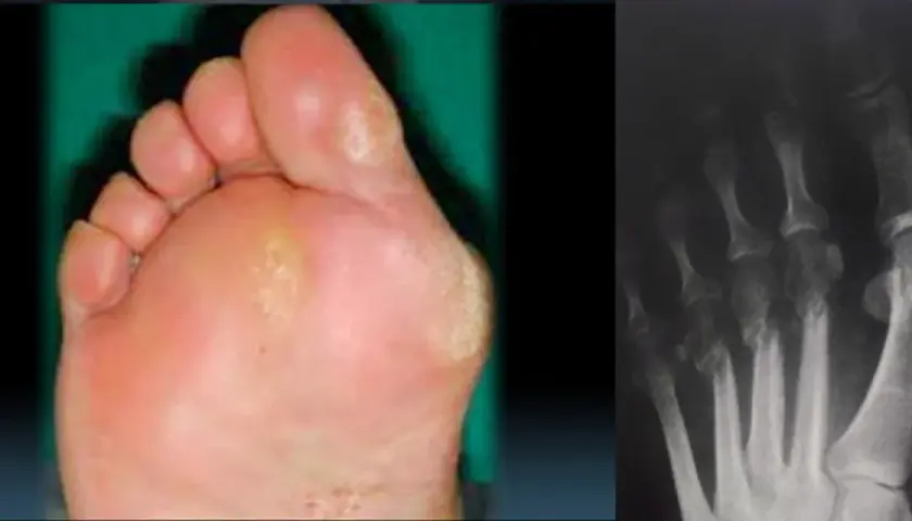Piede con callosità e radiografia delle ossa metatarsali, possibili cause di metatarsalgia.