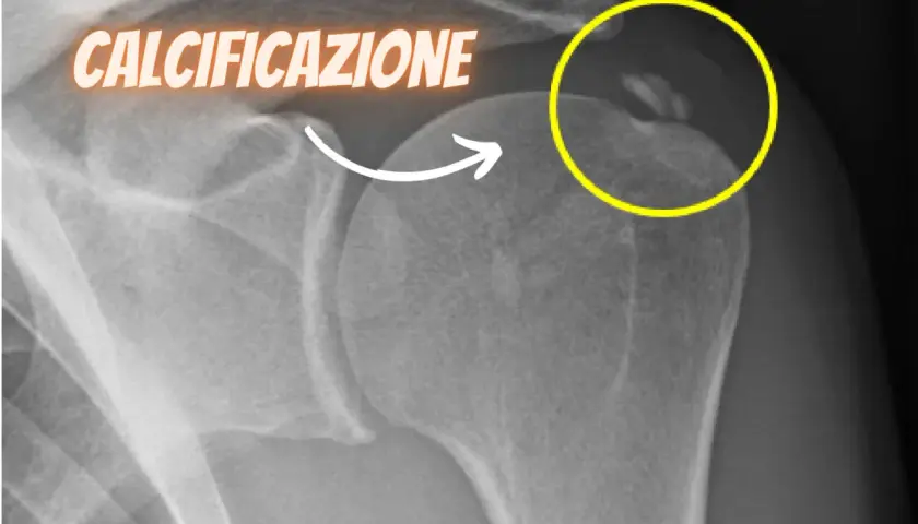 Radiografia spalla: calcificazioni evidenziate in giallo, indicative di tendinopatia calcifica.