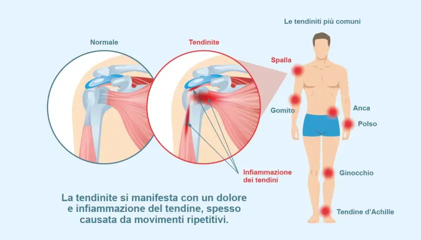 Illustrazione che mostra la differenza tra un tendine normale e uno infiammato, evidenziando le zone più colpite dalla tendinite e come si cura.
