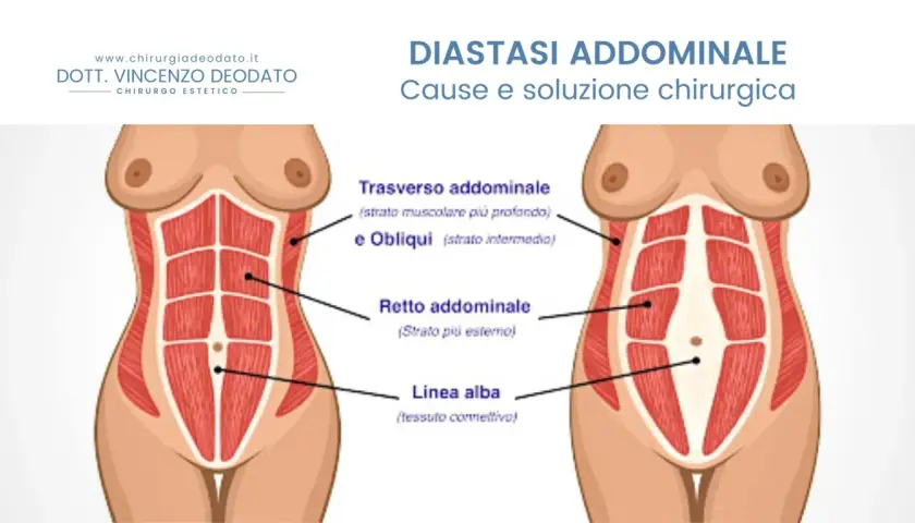 Illustrazione anatomica addominale che mostra la diastasi addominale, una condizione che può peggiorare se non trattata.