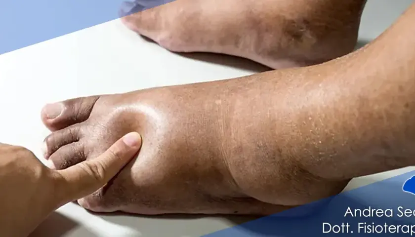 Piede gonfio con evidente imbibizione edematosa, segno di accumulo di liquidi.