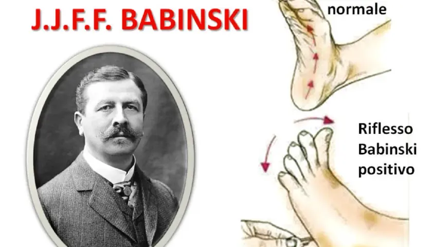 Ritratto di J.J.F. Babinski accanto a illustrazioni del riflesso normale e del riflesso Babinski positivo.
