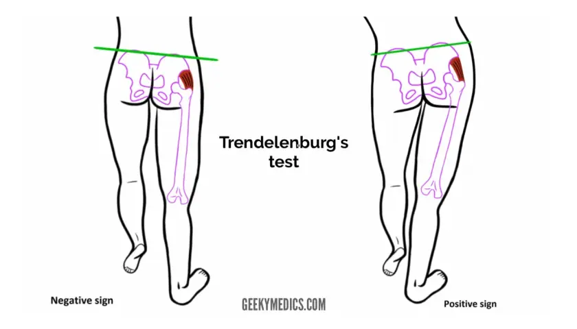 Illustrazione del test di Trendelenburg: bacino livellato (negativo) vs. bacino inclinato (positivo), evidenziando la debolezza del gluteo medio.