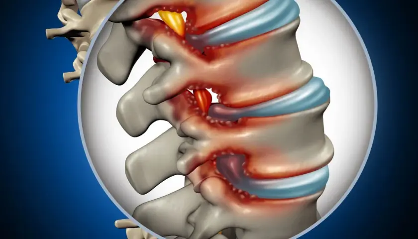 Dettaglio anatomico della colonna vertebrale lombare con infiammazione e compressione nervosa. Si può guarire da una stenosi lombare con le giuste cure.