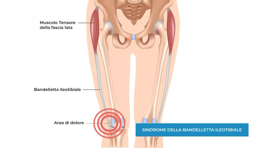 Illustrazione anatomica del ginocchio che mostra la bandelletta ileotibiale e l'area di dolore, indicando la sindrome della bandelletta ileotibiale che non guarisce.