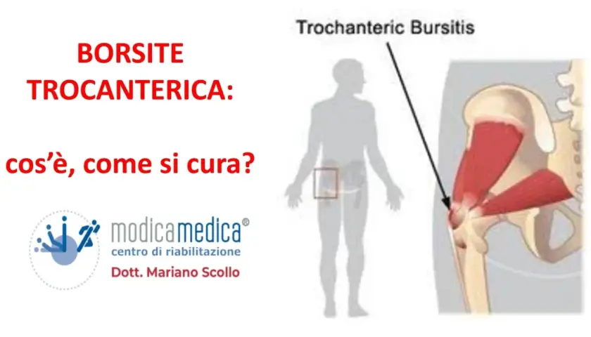 Illustrazione anatomica della borsite trocanterica, con indicazione della zona interessata e del centro di riabilitazione Modicamedica.
