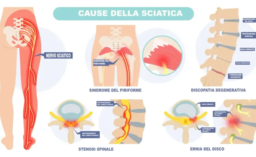 Dolore del nervo sciatico - cosa fare per stare meglio