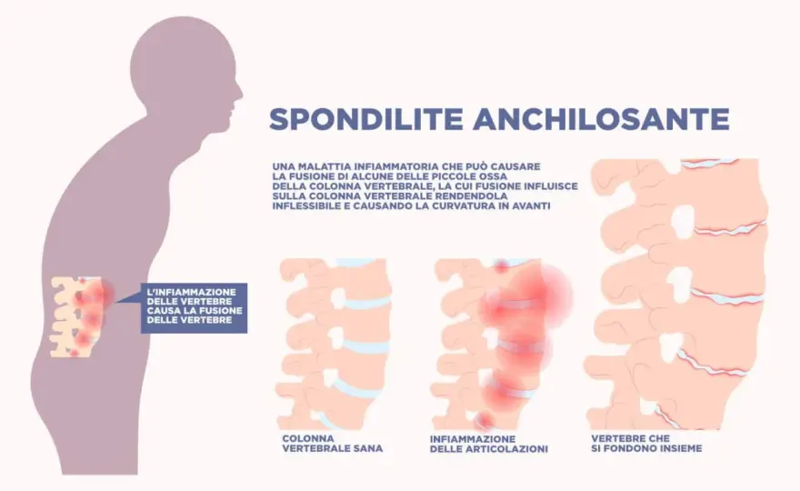 Spondilite anchilosante e aspettativa di vita - cosa sapere