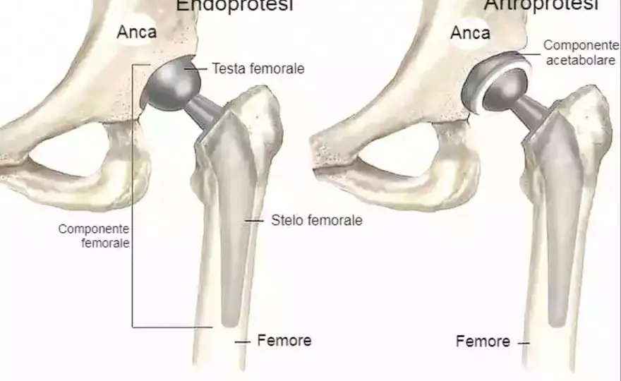 Protesi totale dell’anca - quando serve e come recuperare