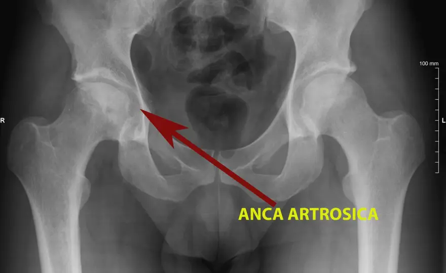 Coxalgia, quali sono i sintomi e quando preoccuparsi?