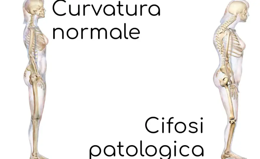 Cifosi, si può guarire? Cosa cambia tra forma posturale e strutturale