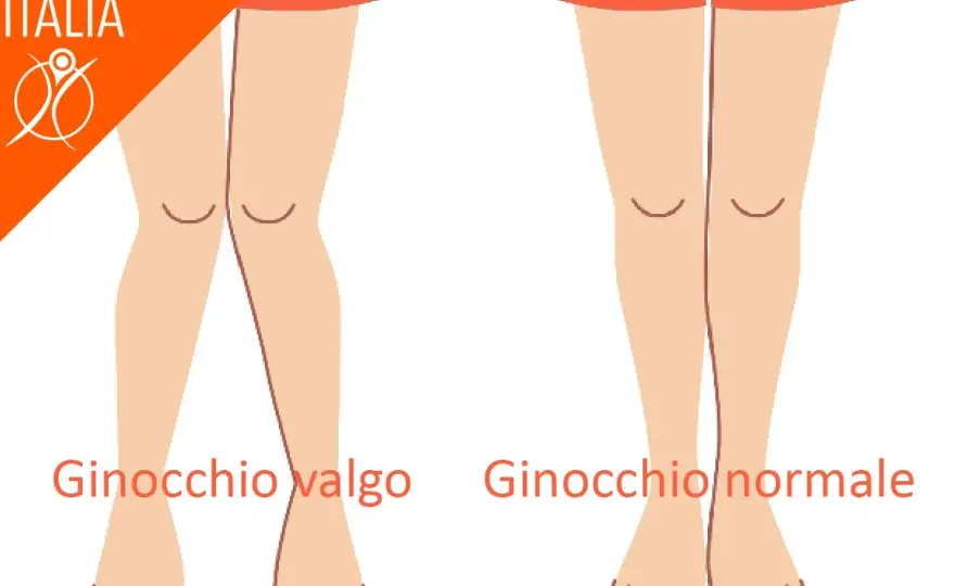 Test in valgo del ginocchio - come si esegue e si interpreta
