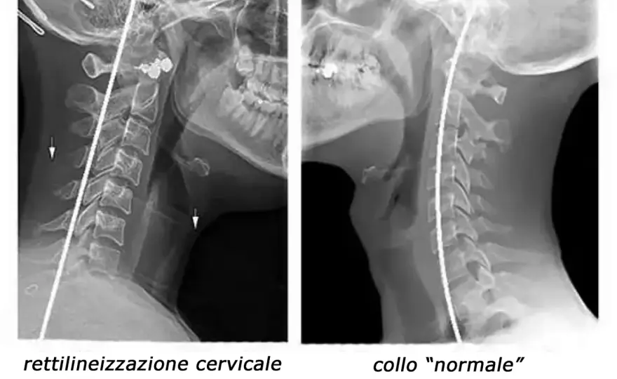 Rettilineizzazione cervicale - significato, sintomi e cosa fare