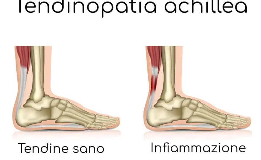 Bruciore ai talloni a riposo, cause e segnali da non ignorare