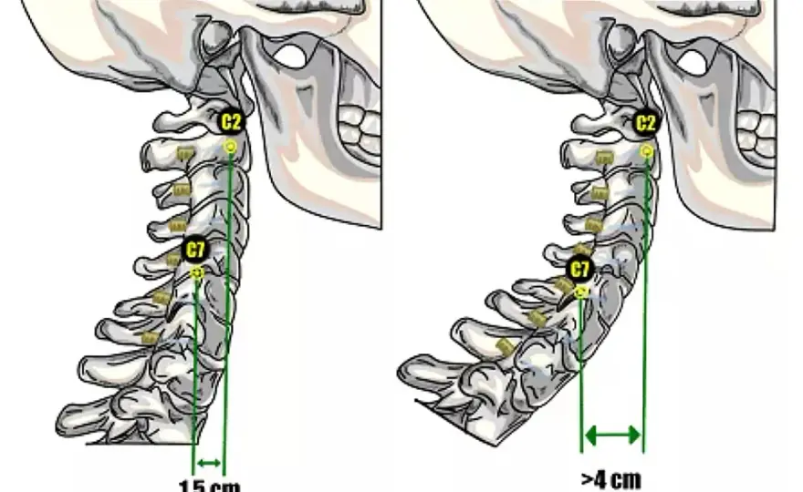 Iperlordosi cervicale, cosa significa e come gestirla