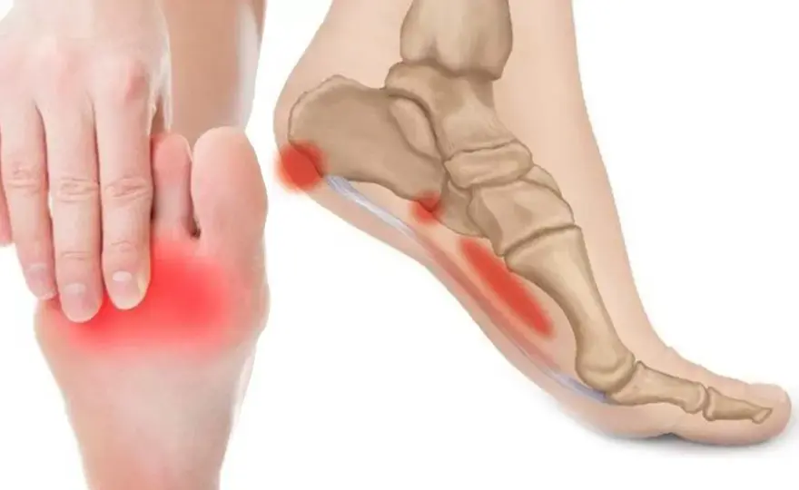 Fascite plantare, quanto dura davvero? Tempi e recupero