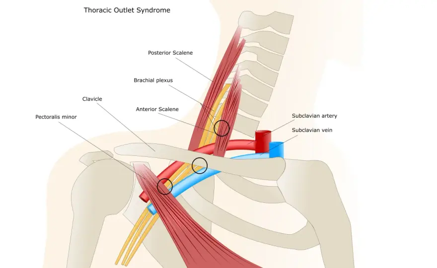 Sindrome dello stretto toracico, quali test servono davvero?