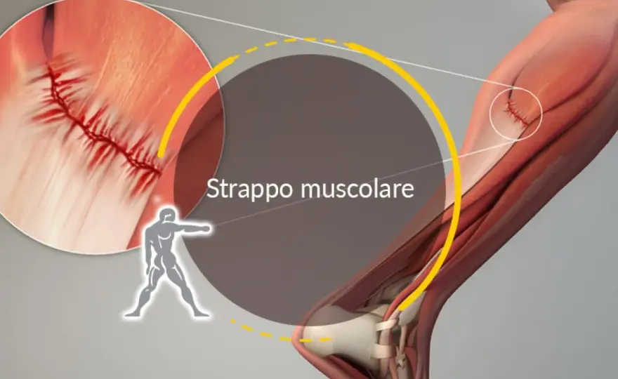 Strappo muscolare, quanto dura il recupero?