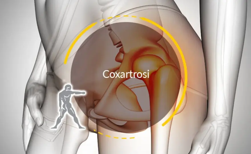 Coxalgia, si può guarire? Cause, recupero e segnali d’allarme