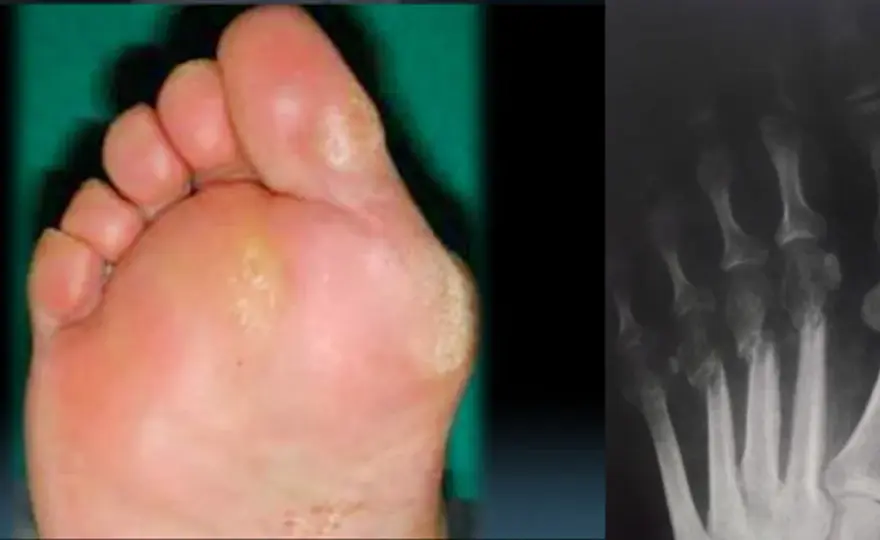 Metatarsalgia - cause, sintomi e cosa fare per il dolore al piede
