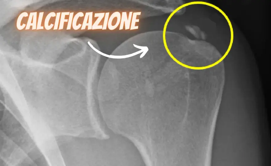 Tendinopatia calcifica della spalla - sintomi e cure