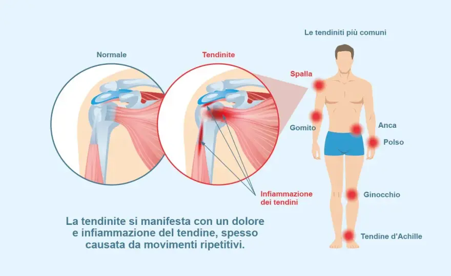 Tendinite, come curarla e quando farsi visitare