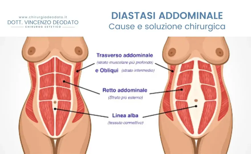 Diastasi addominale, può peggiorare? Segnali e cosa fare