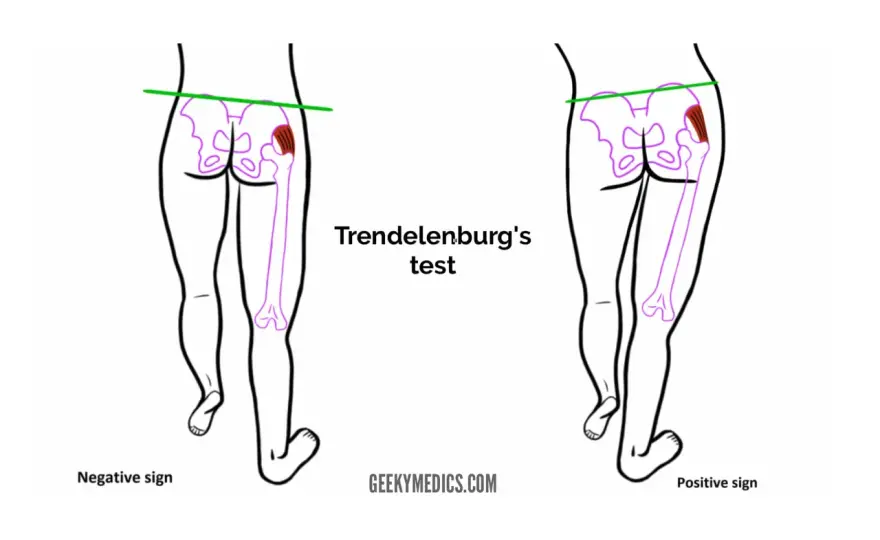 Segno di Trendelenburg - come si esegue e cosa indica