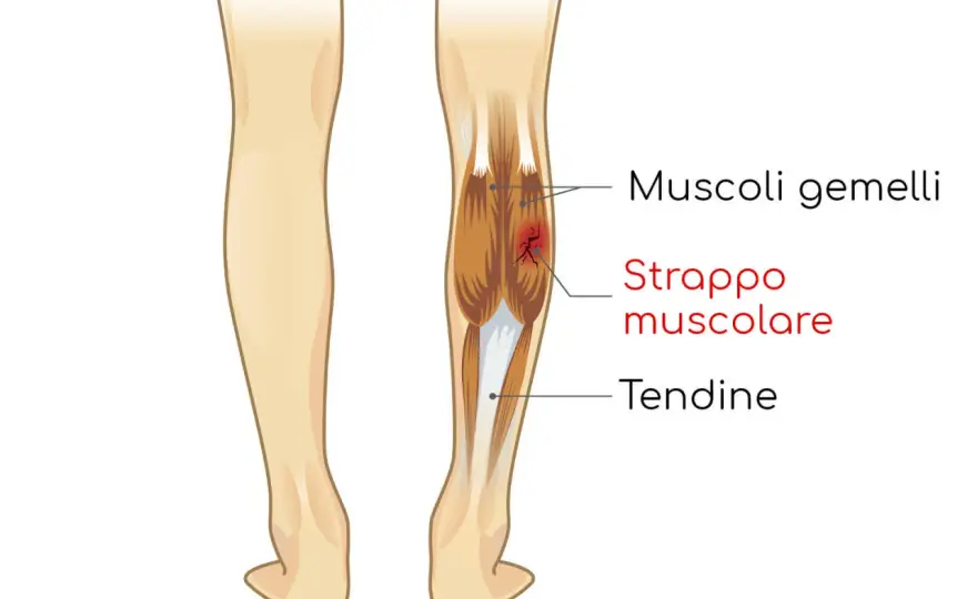 Strappo muscolare cicatrizzato male - segnali e recupero