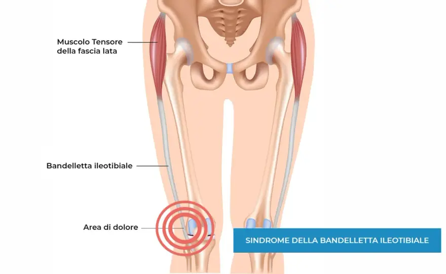 Bandelletta ileotibiale che non guarisce? Cosa fare davvero