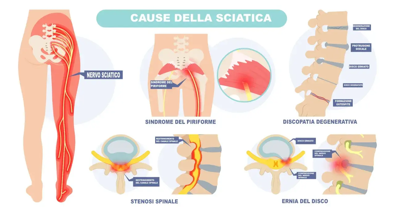 Illustrazione delle cause della sciatica: nervo sciatico, sindrome del piriforme, discopatia degenerativa, stenosi spinale ed ernia del disco. Addio al dolore del nervo sciatico.