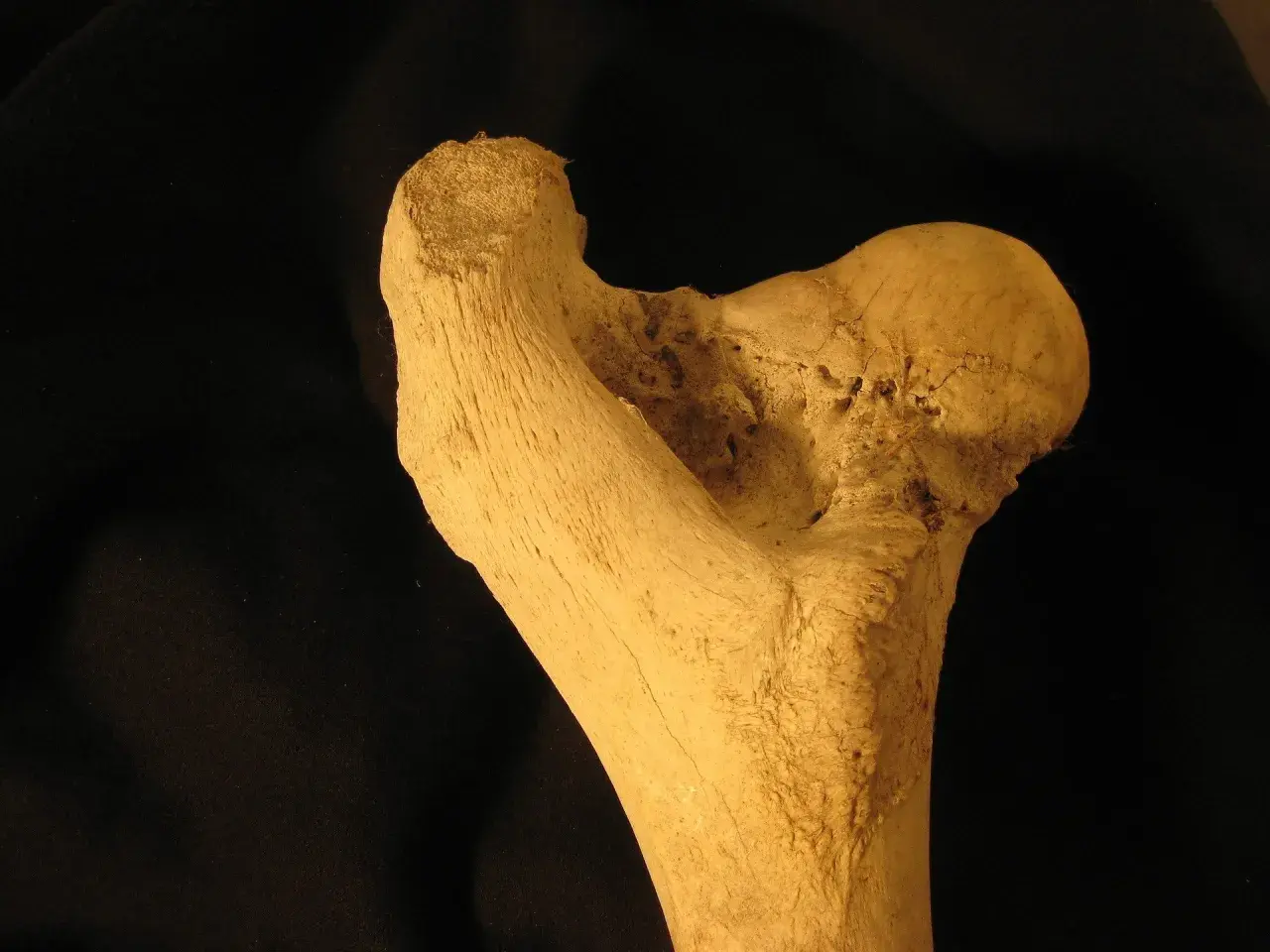 Frammento osseo con segni di necrosi testa femore. La terapia farmacologica è fondamentale per contrastare questa condizione.