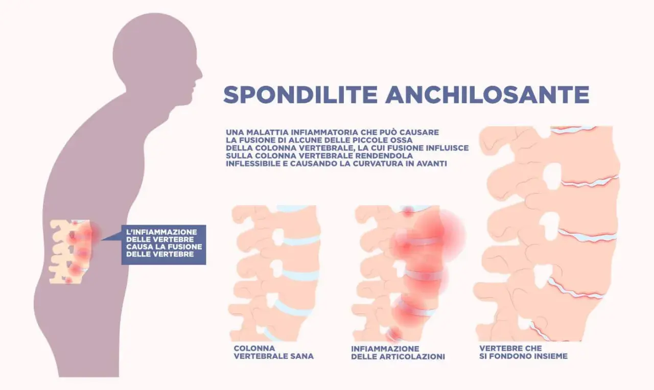 Illustrazione della spondilite anchilosante: infiammazione vertebrale che causa fusione, rigidità e curvatura. La durata vita non è influenzata significativamente.
