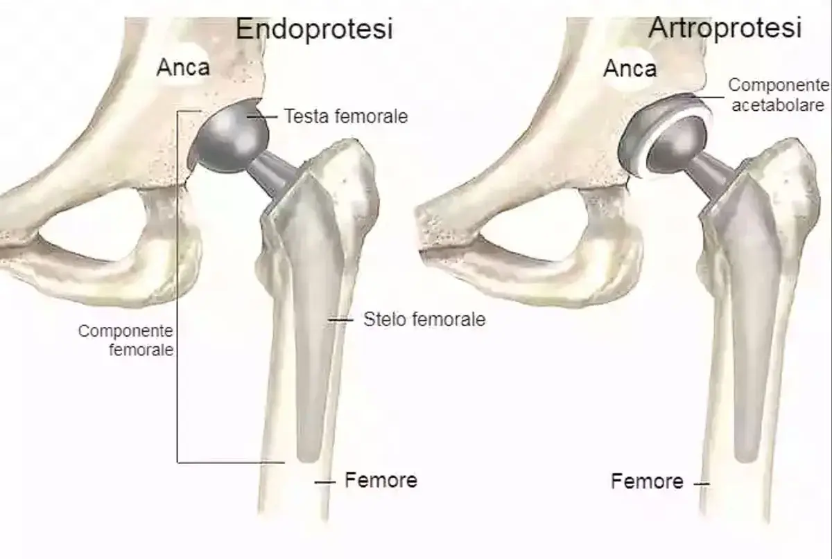 Illustrazione comparativa di protesi d'anca: endoprotesi e artroprotesi. La protesi totale d'anca sostituisce l'articolazione danneggiata.