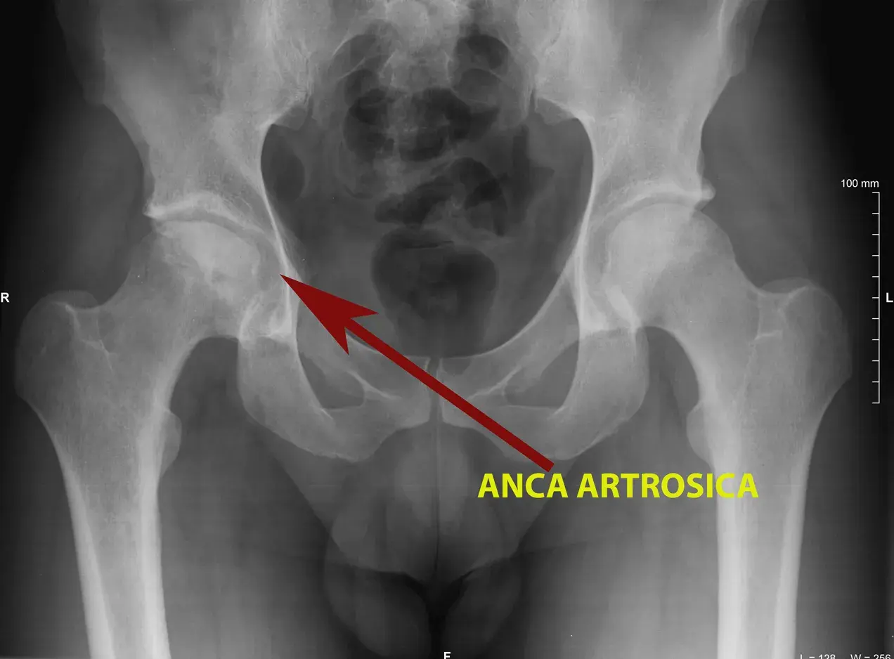 Radiografia del bacino che mostra un'anca artrosica, con freccia rossa che indica l'area interessata, suggerendo possibili coxalgia sintomi.