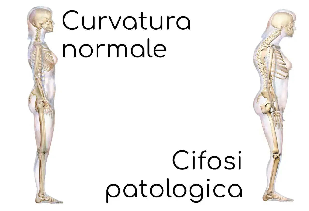 Confronto tra colonna vertebrale con curvatura normale e cifosi patologica. Si guarisce dalla cifosi?
