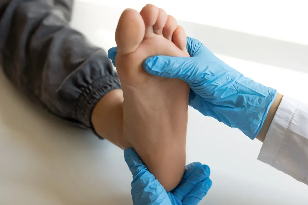 Mani con guanti blu esaminano la pianta del piede, valutando la metatarsalgia plantare.