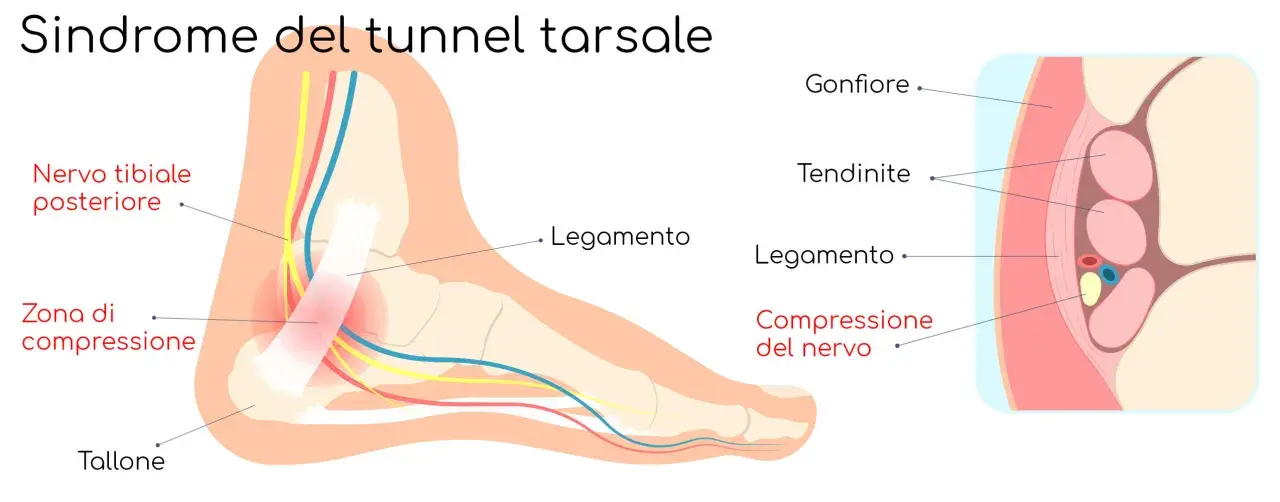 Illustrazione anatomica del tunnel tarsale: nervo tibiale posteriore compresso, gonfiore e tendinite.