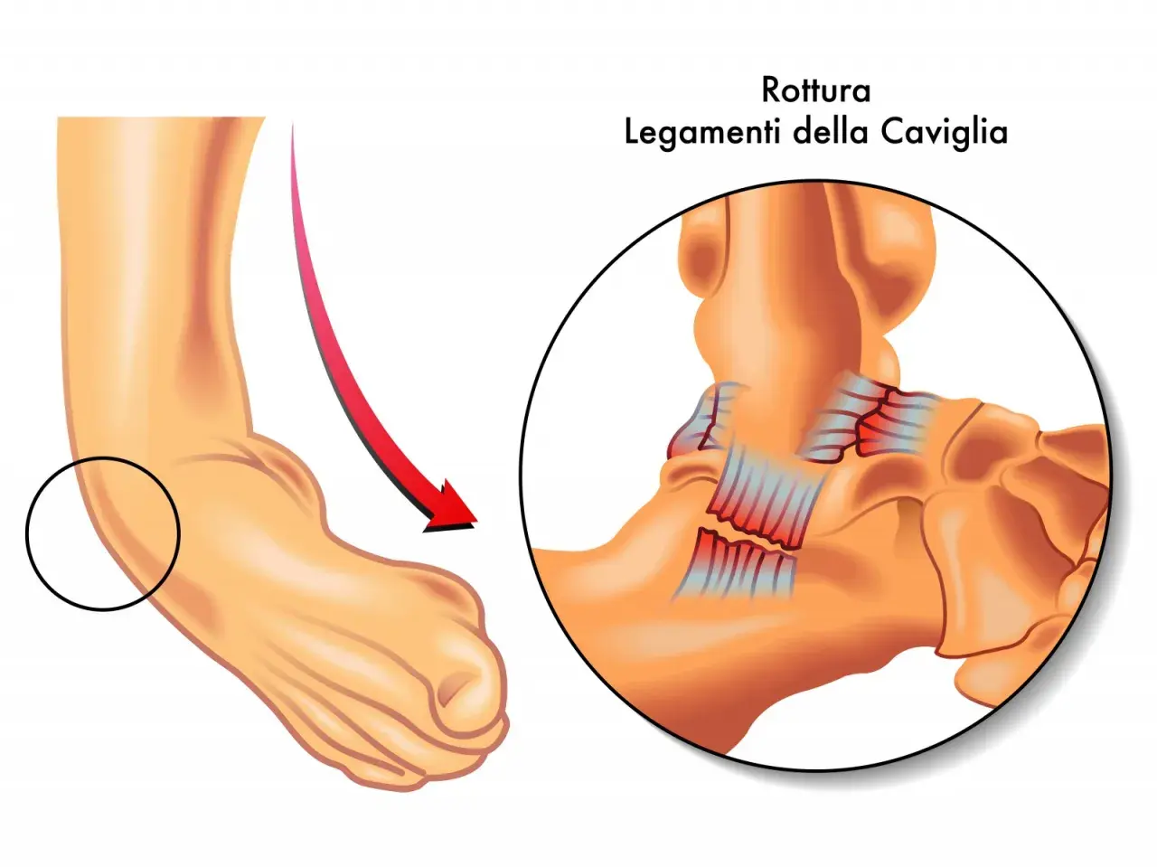 Illustrazione di una caviglia con un cerchio che evidenzia la zona interessata da una rottura dei legamenti, mostrando la sindesmosi caviglia.