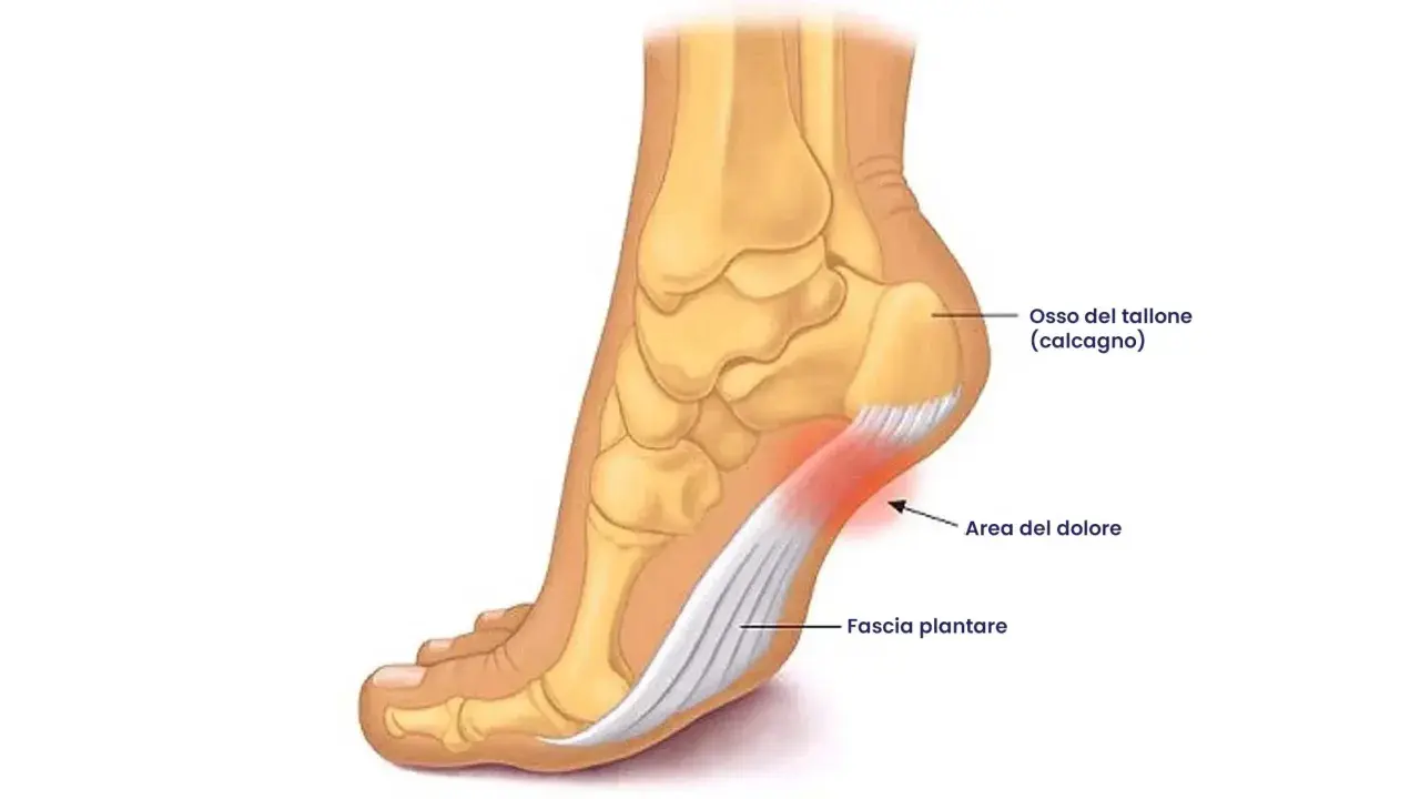 Illustrazione anatomica del piede che mostra l'osso del tallone e la fascia plantare. L'area rossa indica il dolore, spiegando perché viene la tallonite.