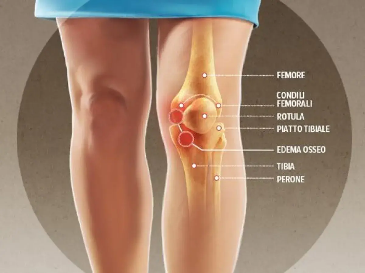 Illustrazione anatomica del ginocchio con evidenziato l'edema osseo.